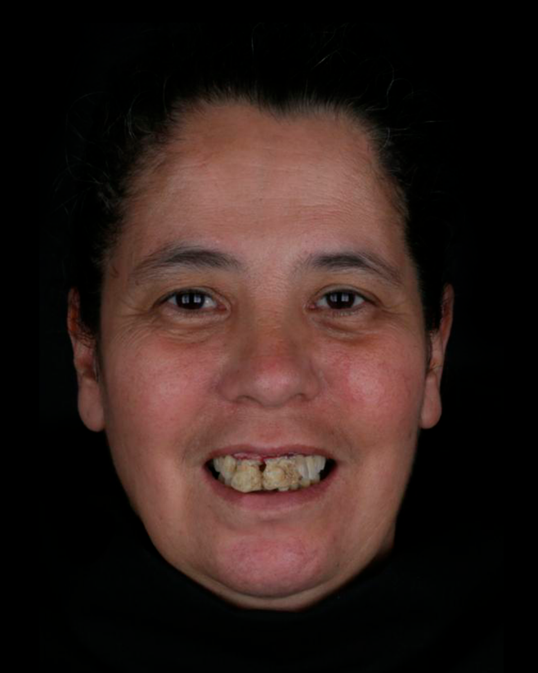 Banner odontovita implantes gravatai protocolo protese fixa protese em gravatai (26)j