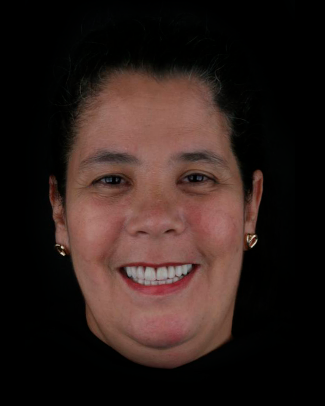 Banner odontovita implantes gravatai protocolo protese fixa protese em gravatai (27)j