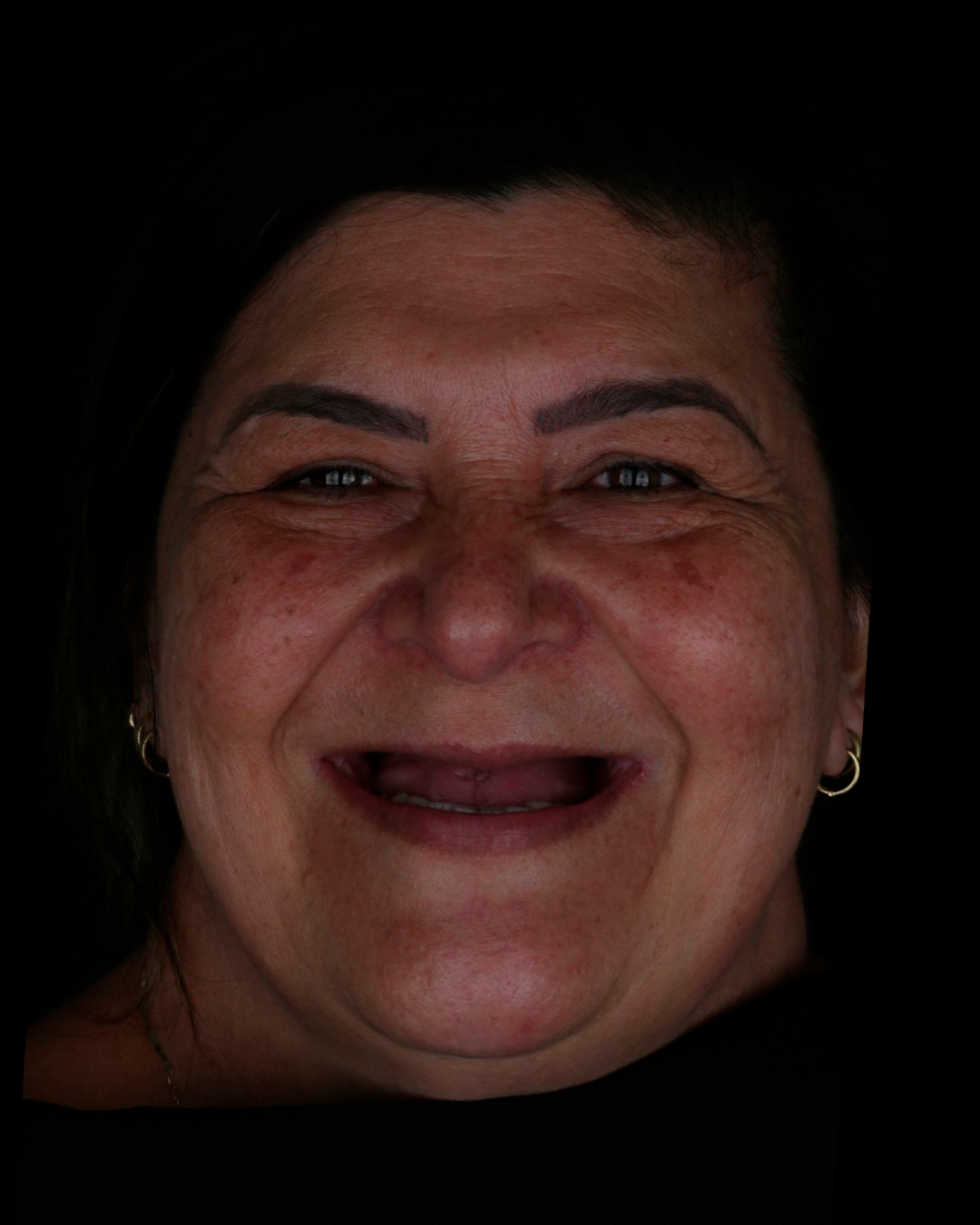 Banner odontovita implantes gravatai protocolo protese fixa protese em gravatai (30)j